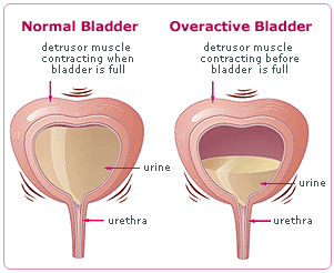 Bladder-overactive