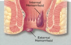 hemorrhoid-pictures